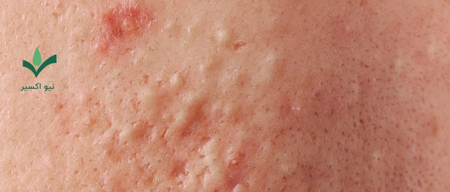 رفع جوش و آکنه با ترب سیاه